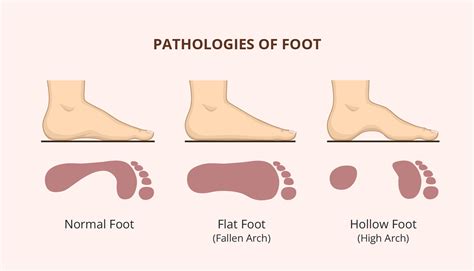 Flat Feet: Causes, Diagnosis, Treatment, and Prevention | Healthnews