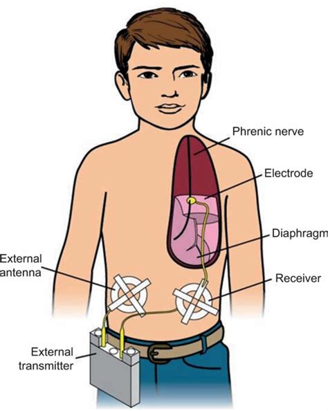 Hypoventilation causes, symptoms and hypoventilation treatment