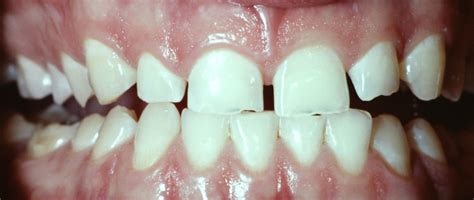 Tooth erosion Q&A: A pop quiz for dental hygienists | Registered Dental Hygienist (RDH) Magazine