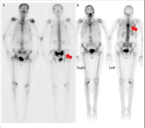 Bone Scan Vs Ct Scan