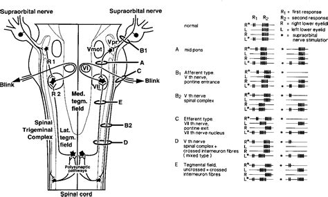 Figure 6 from The late blink reflex response abnormality due to lesion ...