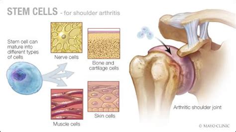 Mayo Clinic Q and A: Stem cell therapy for arthritis - Mayo Clinic News Network