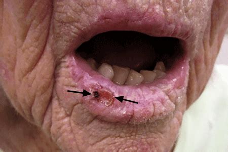 Squamous Cell Carcinoma | Advanced Dermatology