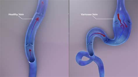 Varicose veins: Symptoms, Causes, and Treatment - Scientific Animations