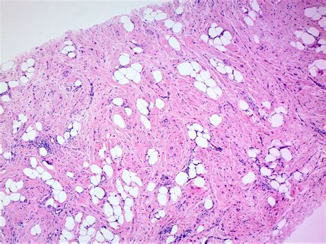 Pathology Outlines - Hamartoma