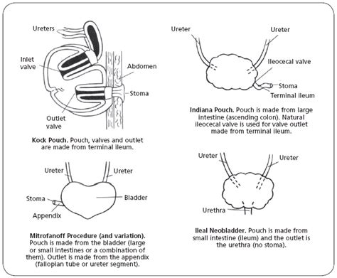 Seeking Healthy Life: What is a Urostomy Surgery? – Types of Urostomy