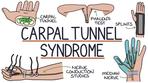 Understanding Carpal Tunnel Syndrome - Ask The Nurse Expert