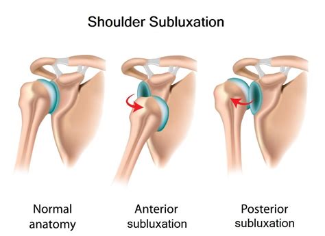 Managing Shoulder Pain After Stroke: 4 Common Causes and Treatments