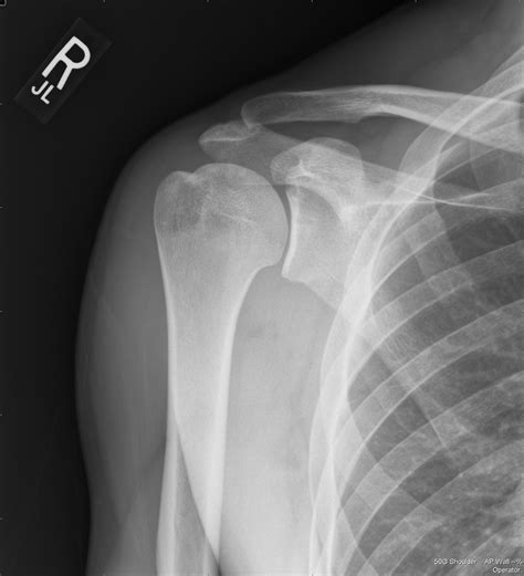 UW Shoulder and Elbow Academy: X-rays for shoulder arthritis