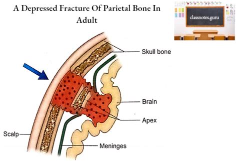 Parietal bone: Anatomy, Borders and Surfaces - Class Notes