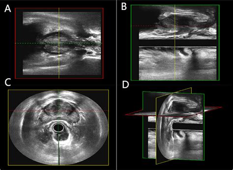 Three-dimensional transrectal ultrasonography (3D-TRUS). (A) Coronal ...