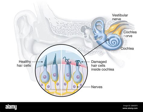 Healthy and damaged hair cells inside cochlea Stock Photo - Alamy