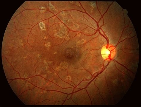 Acute Posterior Multifocal Placoid Pigment Epitheliopathy Late Stage Scar Formation - Retina ...