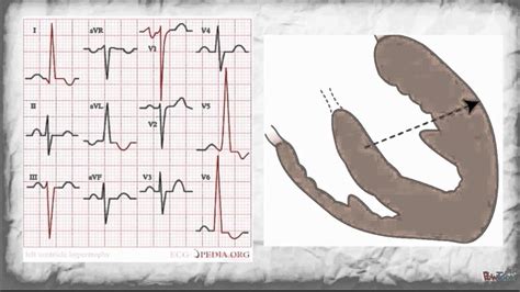 How to Read a Pediatric EKG - YouTube