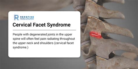 Cervical Facet Syndrome - NJ's Top Orthopedic Spine & Pain Management ...