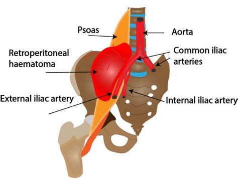 Retroperitoneal Bleed Ultrasound