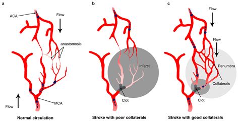 IJMS | Free Full-Text | Improving Cerebral Blood Flow after Arterial Recanalization: A Novel ...