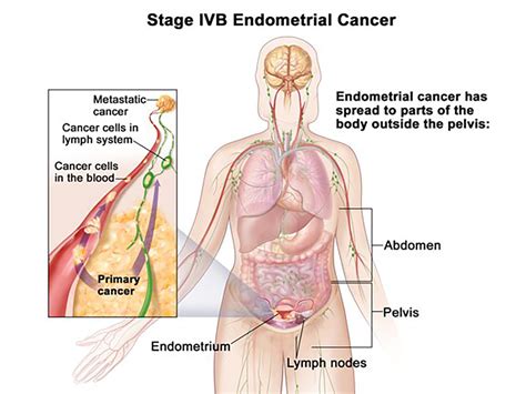 Immunotherapy drug shows promise in advanced endometrial cancer