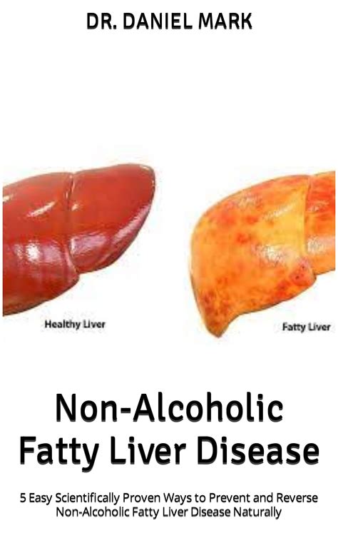 Non-Alcoholic Fatty Liver Disease : 5 Easy Scientifically Proven Ways to Prevent and Reverse Non ...