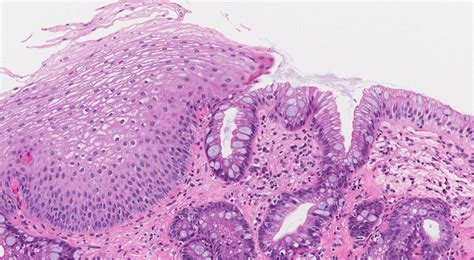 Barretts esophagus | MyPathologyReport.ca