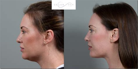 Coolsculpting Chin B&A | Seiler Skin