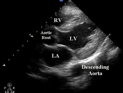 TTE for Aortic Dissection/ Thoracic Aneurysm? ~ Ultrasound Cases Info