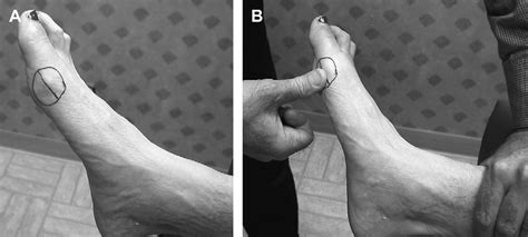 Test for strength of the tibialis posterior; foot must be plantarflexed... | Download Scientific ...