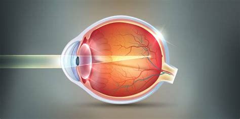 Myopia Correction Surgery: Everything Important You Need To Know