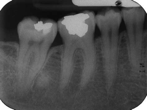 Enostosis – Dr. G's Toothpix