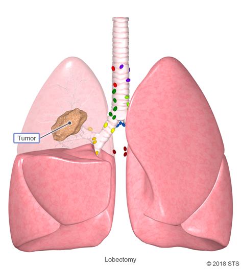 Lobectomy | The Patient Guide to Heart, Lung, and Esophageal Surgery