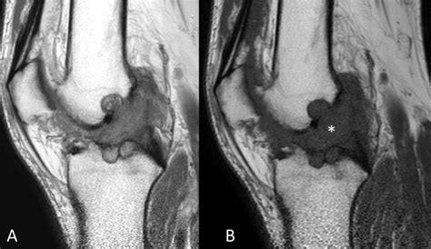 Anterior cruciate ligament mucoid degeneration: MR findings | Eurorad