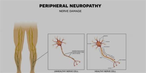 Pain In Hands Or Feet Can Be Symptoms Of Peripheral Neuropathy. Know Causes, Complications and ...