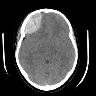 Imaging in Epidural Hematoma: Practice Essentials, Radiography ...