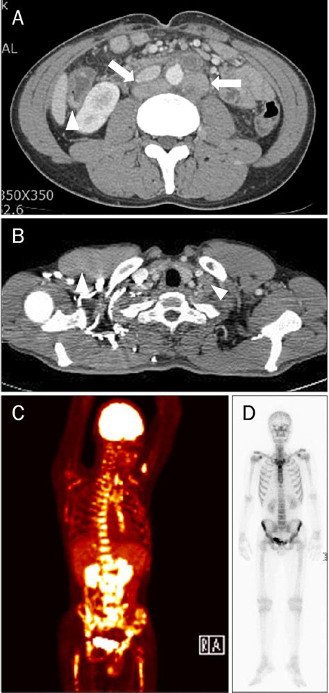 Staging work-up results. (A) Abdomen CT scan shows multifocal enhancing... | Download Scientific ...