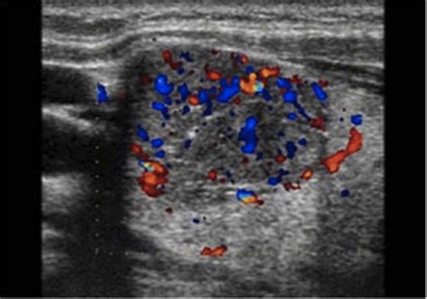 Malignant Thyroid Nodules