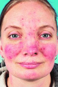 Papulopustular rosacea causes, symptoms, diagnosis & treatment