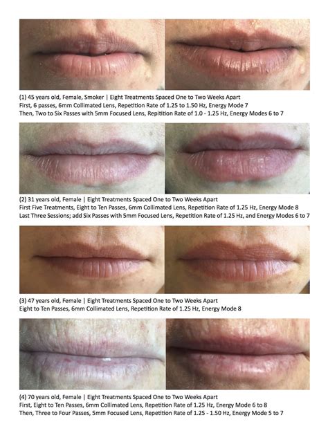 Lip Rejuvenation and Lip Plumping with 650-microsecond Pulsed Nd:YAG ...