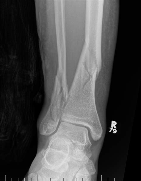 Distal Tibial Fractures | The Bone School