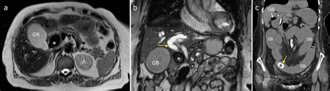 Gallstone Ileus - Radiology at St. Vincent's University Hospital