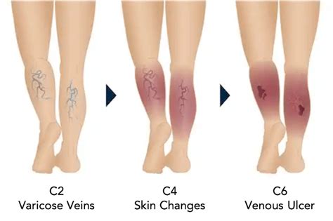 What Is Chronic Venous Insufficiency Causes Symptoms And Treatments | Hot Sex Picture