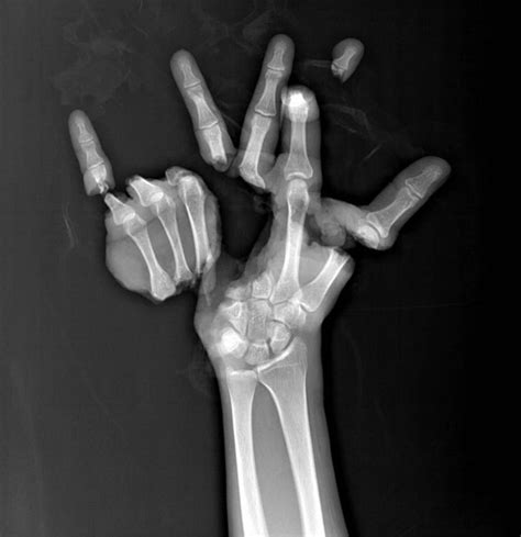 X ray of broken pinky finger: Broken Finger Symptoms, X-Ray, Tips, Treatment, Surgery & Pictures