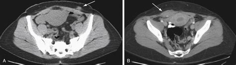 Endometriosis | Radiology Key