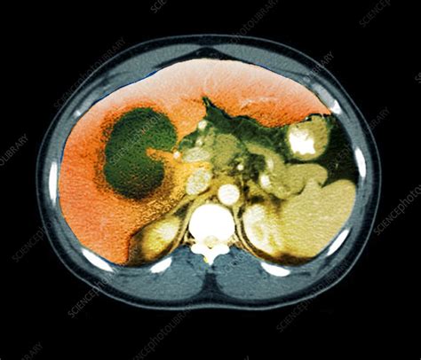 Liver abscess, CT scan - Stock Image - C026/7956 - Science Photo Library