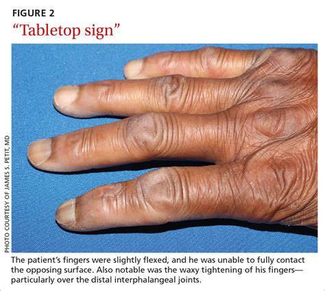 Waxy fingers and skin tethering | MDedge Family Medicine