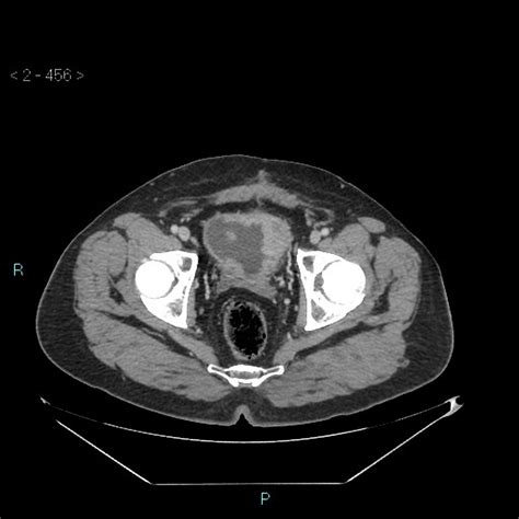 Bladder cancer CT - wikidoc