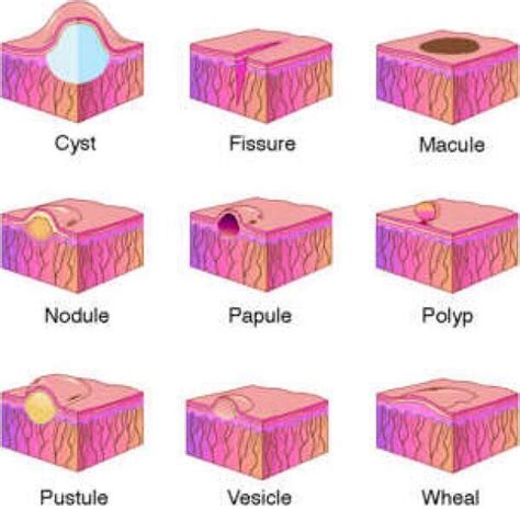 #pustule #fissure #vesicle #lesion #macule #nodule #papule #polyp # ...