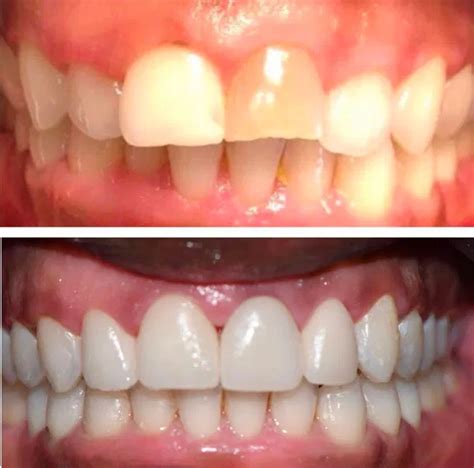 Before and After Photos | Thrive Dental