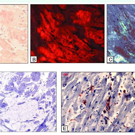 Representative images of AL amyloidosis. (A) Congo red stain under... | Download Scientific Diagram