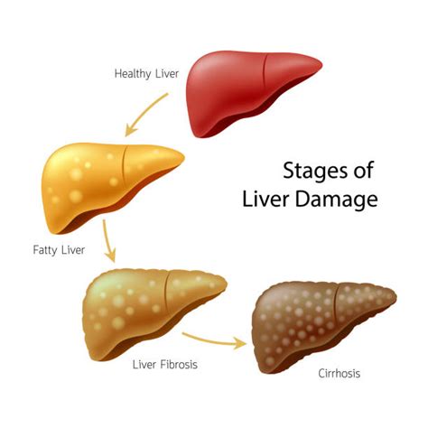 Liver Cirrhosis Illustrations, Royalty-Free Vector Graphics & Clip Art ...