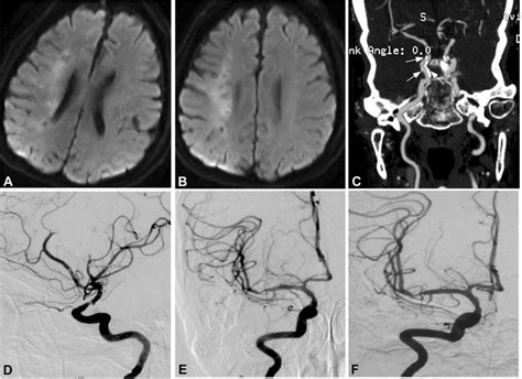 Right internal carotid artery severe stenosis. (A) Magnetic resonance ...